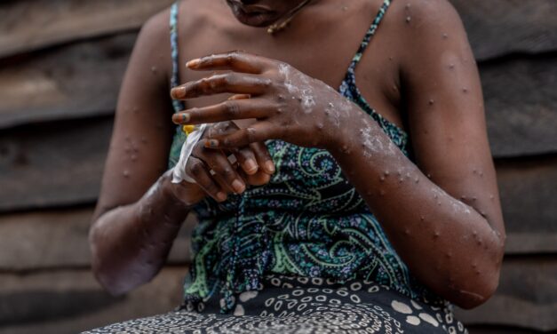 Why one doctor says we’re ‘walking blind’ in the mpox emergency