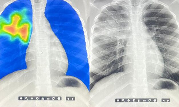 AI steps in to detect the world’s deadliest infectious disease